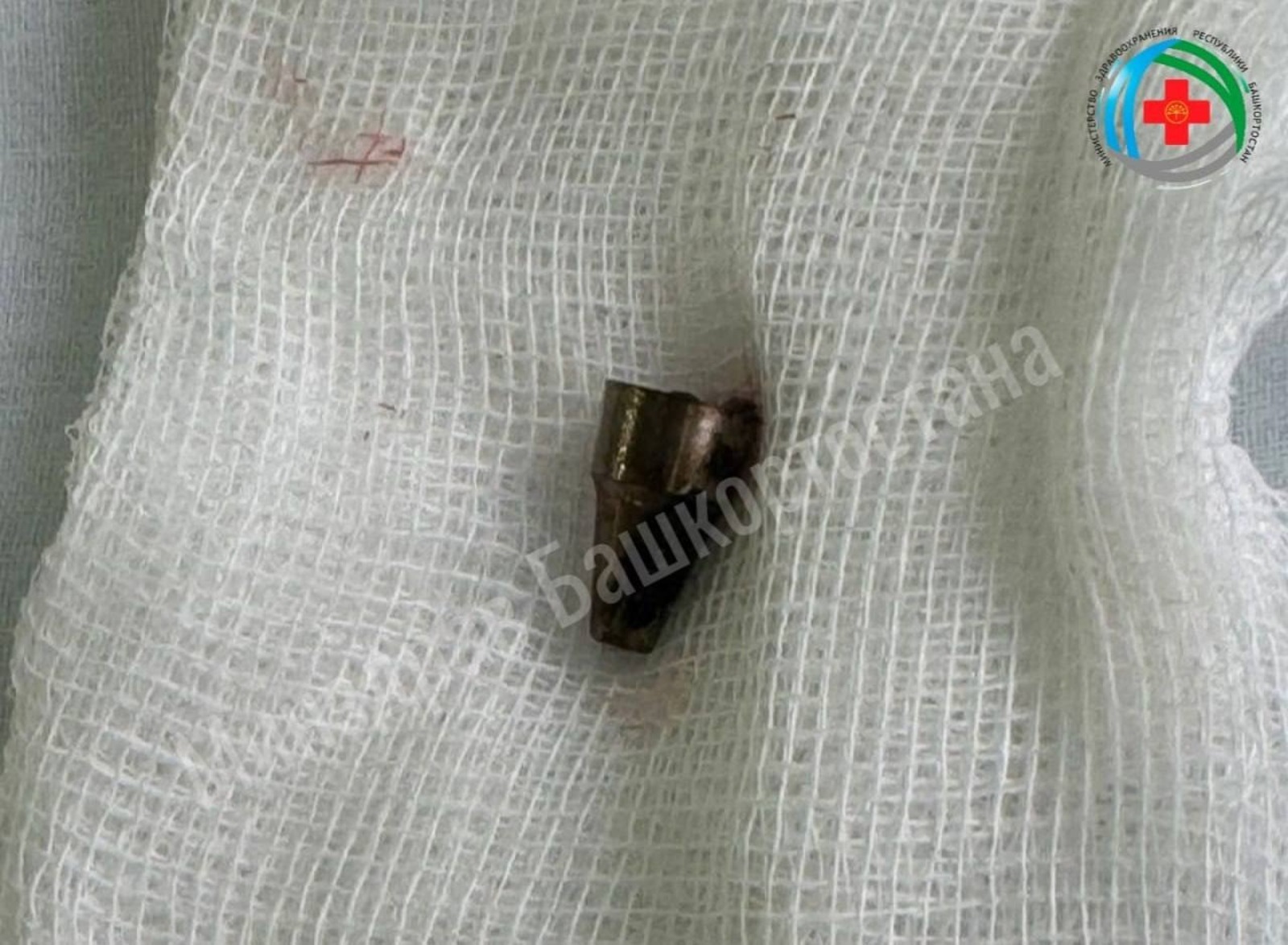 Хирурги Уфы достали из уха пациентки наконечник ручки